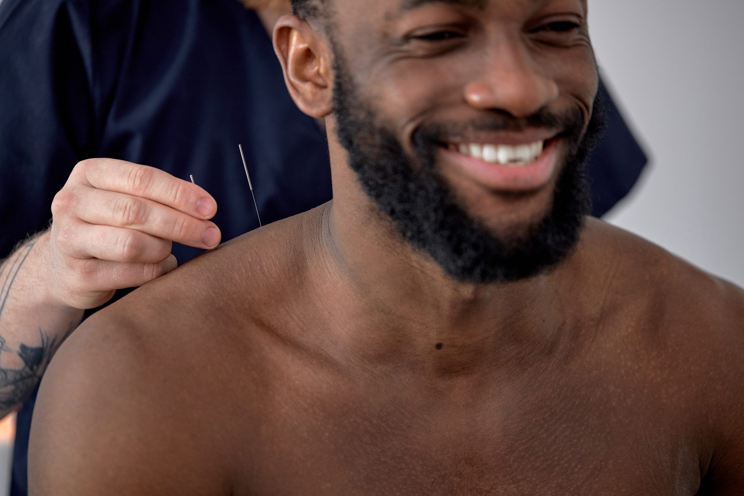 3 Times When You Should Choose Acupuncture Instead Of Traditional Medicine